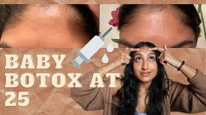 Baby botox at 25
