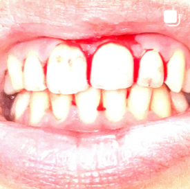 Bloody teeth