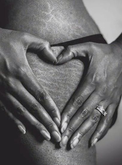 Love-Stretchmarks